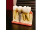 Dental Implants in Hyderabad: The Ultimate Solution for Missing Teeth