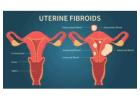 UFE fibroids: The Key to Tackling Large Fibroids