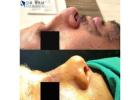 Rhinoplasty Nose Surgery in Punjab