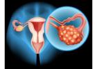 Ovarian Cyst Perimenopause Can Cause Ovary Pain - Dr Kade