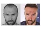 Transform Your Look at the Best Hair Transplant Clinic in Delhi: Myo Clinix