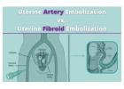 Is Uterine Artery Embolization the Solution for You?