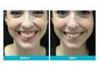 Smile Makeovers Cost In India