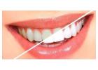 Best Teeth Whitening in Bangalore | teeth whitening cost