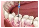 Top-Notch Root Canal Treatment in Kolkata