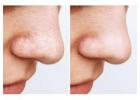 Best Blackhead Removal Clinic in Hyderabad - FMS Skin & Hair Clinic