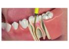 Effective Root Canal Treatment Cost in India