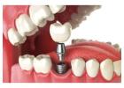 Best Dental Implant Clinic in Kolkata