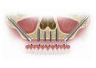 Best Zygomatic Dental Implants in India