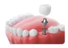 Dental Implant in  Jadavpur