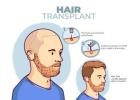 Achieve Natural Hair at the Best Hair Transplant Clinic in Delhi: Myo Clinix