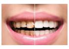 Full Mouth Rehabilitation Treatment in Ahmadabad | 9825158578