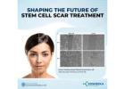 Shaping the Future of Stem Cell Scar Treatment