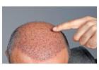 Hair Fall Treatment in Delhi - Skinology Clinic