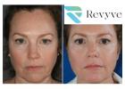 Face Lifting and Skin Tightening Skin Doctor in Faridabad