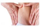 Stretch Marks Treatment in Delhi - Skinology Clinic