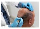 Get Natural Hair with the Best Hair Transplant Clinic in Delhi: Myo Clinix