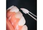 Best Dental laminate clinic in Dubai UAE