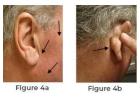 Parotid Tumor Surgery