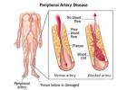 Top Peripheral Artery Disease Specialist | Midas Care Clinic