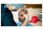 Looking For the Best Hair Transplant Clinic in Delhi for Lasting Results: Myo Clinix