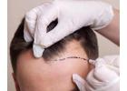 Best Hair Transplant in Delhi