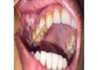 Best Oral cancer treatment in Dubai UAE