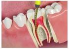 Premium Dental Implants in Kolkata