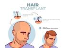 Choose the Right Clinic for the Best Hair Transplant Treatment in Delhi: Myo Clinix