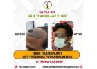 hair transplant in chennai