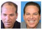 Best Hair Transplant Doctor in Richmond, VA