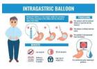 Intragastric Balloon for Weight Loss at Laparo Obeso Centre 