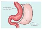 Sleeve Gastrectomy for Weight Loss at Laparo Obeso Centre