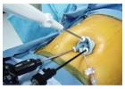 Single Incision Sleeve Gastrectomy at Laparo Obeso Centre 