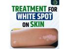 Vitiligo Causes and Natural Solutions: Effective Treatment For White Spot on Skin