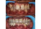 Orthodontic Treatment in Coimbatore