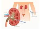 Percutaneous Nephrolithotomy Hospitals in Saltlake