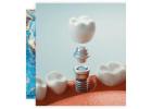 Top-Quality Dental Implants in Columbia, SC | Soda City Dentistry