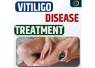 Vitiligo Disease Treatment: Effective Medication for Skin Pigmentation Recovery