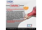 Cellulitis Treatment in Hyderabad