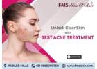 Best Acne Treatment in Hyderabad | FMS Skin & Hair Clinic