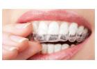 Best Treatment For Invisalign in Tanglin