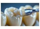 Dental Sealants in the UK