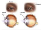 Best Cataract Treatment