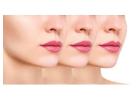 lip fillers in Delhi