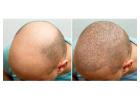 Hair Transplant treatment