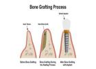 Best Bone grafting treatment in Dubai UAE