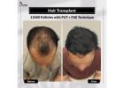 Restore Your Confidence with the Best Hair Transplant in India