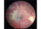 Epiretinal membrane San Diego | Retina Center of San Diego