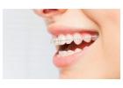 Adult Orthodontic Braces in the UK: MD.co.uk